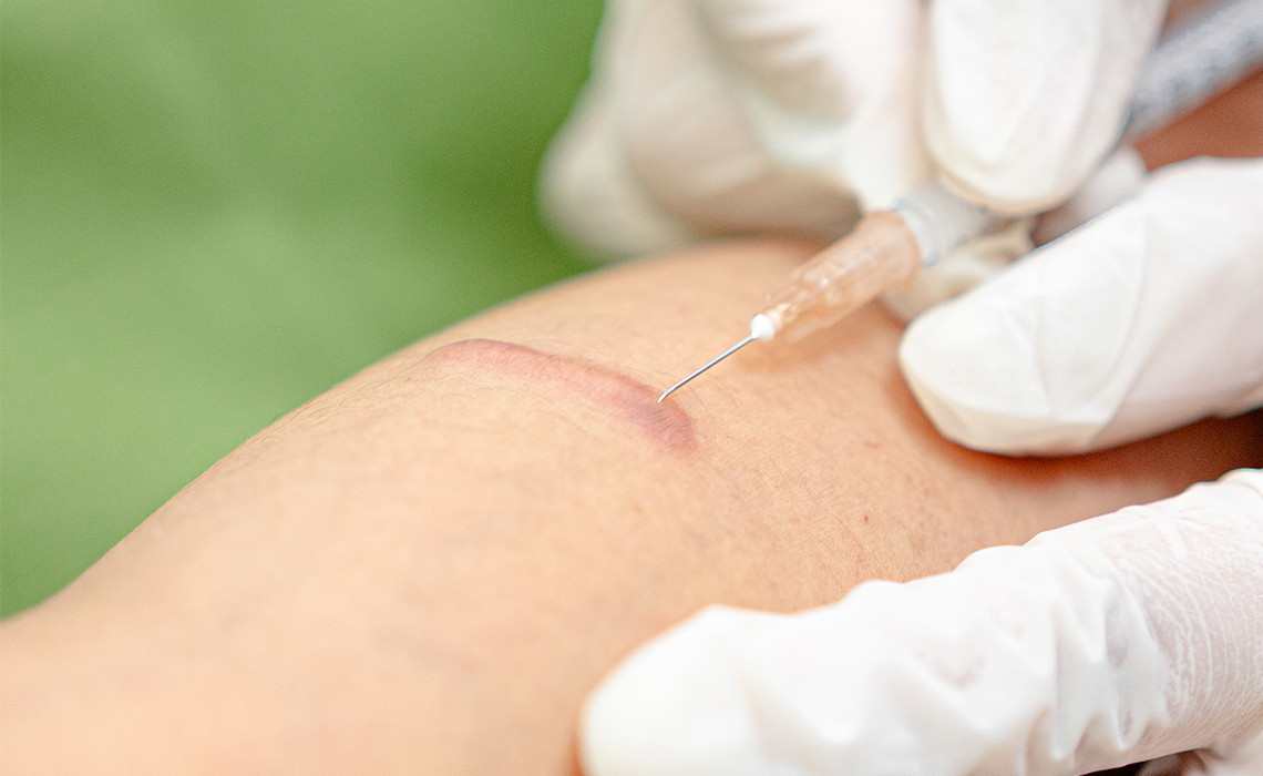 INJEKSI KELOID | Blog | Brisha Store