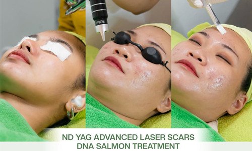 ND YAG ADVANCED LASER SCARS DNA SALMON TREATMENT | Brisha Store